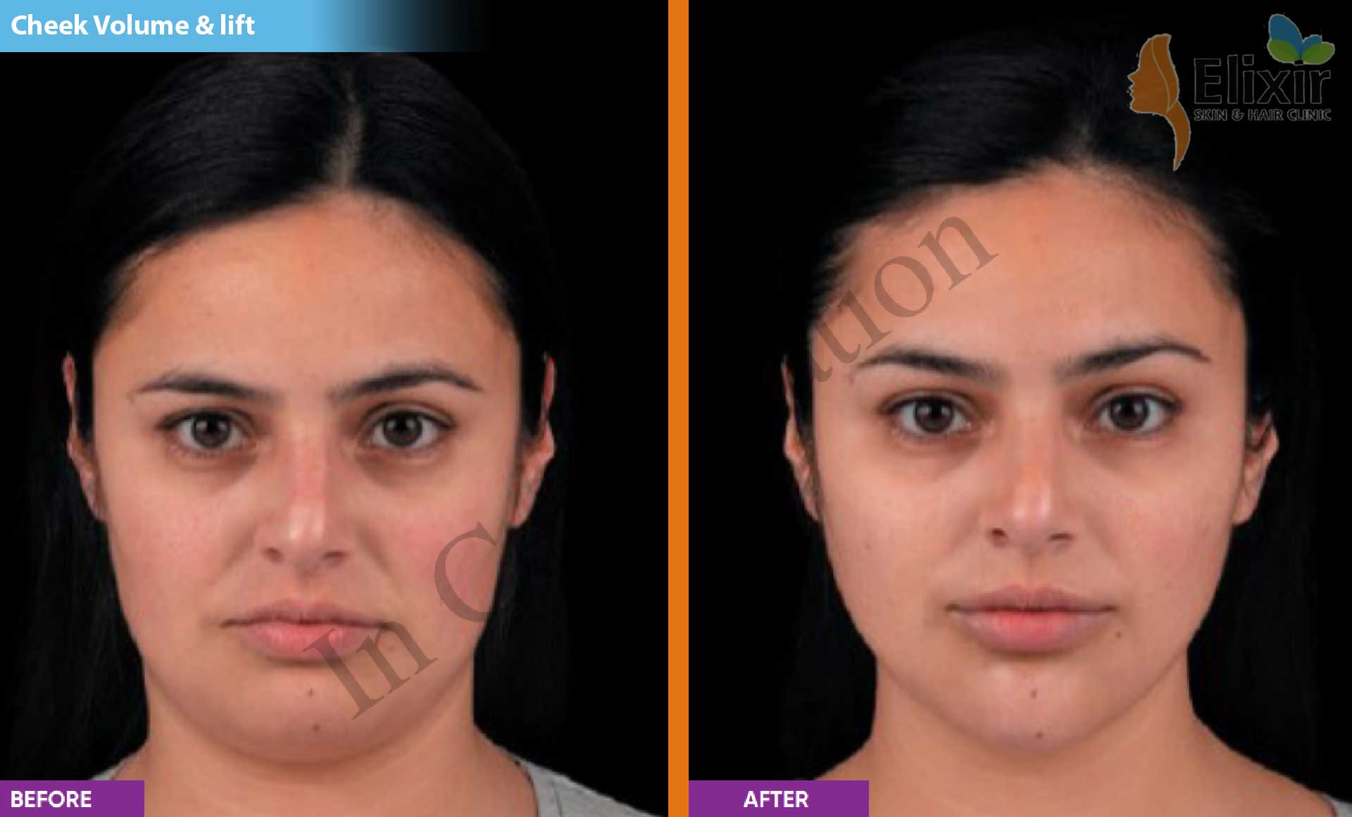 Elixir Anti Aging Dermal Fillers