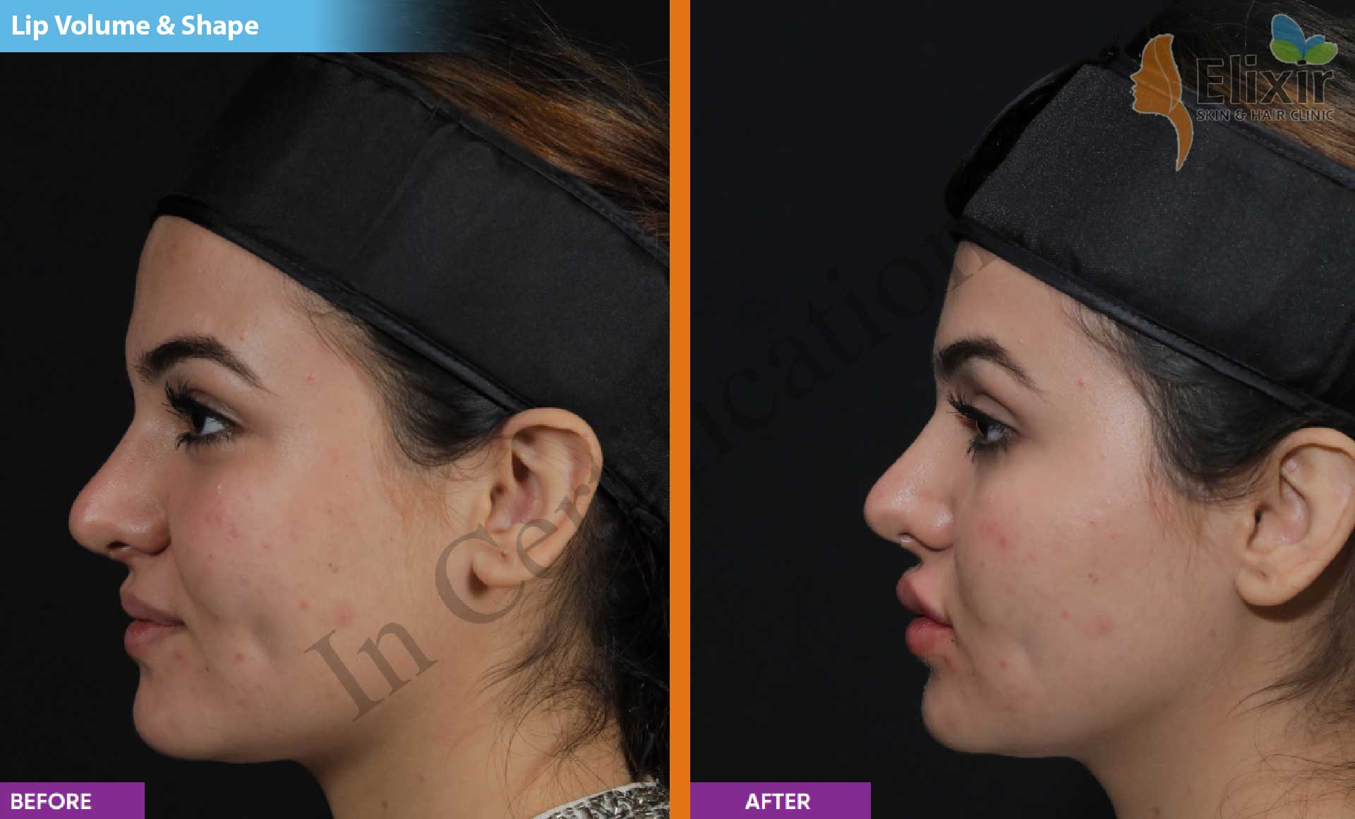 Elixir Anti Aging Dermal Fillers